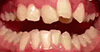 dental-braces-movement0.2